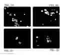 Fig. 02 - Markers for preeclampsia