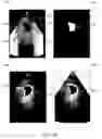 Fig. 11 - METHOD AND SYSTEM FOR MEASURING A VOLUME FROM AN ULTRASOUND IMAGE