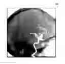 Fig. 01 - Angiographic roadmapping mask