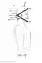 Fig. 19 - Headgear for reducing head trauma