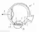 Fig. 01 - IMPLANT FOR DETERMINING INTRAOCULAR PRESSURE