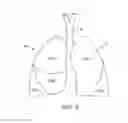 Fig. 11 - Functional assessment and treatment catheters and methods for their use in the lung