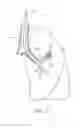 Fig. 13 - Functional assessment and treatment catheters and methods for their use in the lung