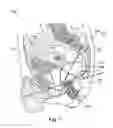 Fig. 02 - Extended balloon assembly for a catheter