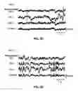 Fig. 10 - Bioresorbable silicon electronics for transient implants