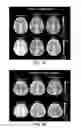 Fig. 08 - Quantitative mapping of cerebrovascular reactivity using resting-state functional magnetic resonance imaging
