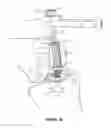 Fig. 11 - Arthoplasty systems and methods for optimally aligning and tensioning a knee prosthesis