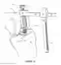 Fig. 13 - Arthoplasty systems and methods for optimally aligning and tensioning a knee prosthesis