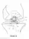 Fig. 20 - Arthoplasty systems and methods for optimally aligning and tensioning a knee prosthesis
