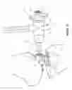 Fig. 24 - Arthoplasty systems and methods for optimally aligning and tensioning a knee prosthesis