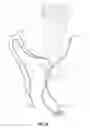 Fig. 08 - TISSUE CINCHING SUTURE SYSTEM THAT IS SLIDELESS AGAINST THE TISSUE DURING CINCHING
