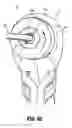 Fig. 23 - Surgical fastener applying apparatus, kits and methods for endoscopic procedures