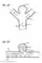 Fig. 14 - DEVICES FOR THERAPEUTIC VASCULAR PROCEDURES