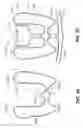 Fig. 25 - DEVICES FOR THERAPEUTIC VASCULAR PROCEDURES