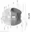Fig. 40 - DEVICES FOR THERAPEUTIC VASCULAR PROCEDURES
