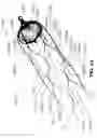 Fig. 47 - DEVICES FOR THERAPEUTIC VASCULAR PROCEDURES