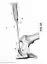 Fig. 04 - Stabilizing microfracture device