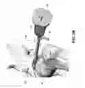 Fig. 05 - Stabilizing microfracture device