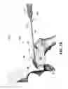 Fig. 11 - Stabilizing microfracture device