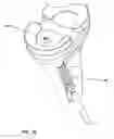 Fig. 16 - Retrograde resection apparatus and method