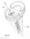 Fig. 17 - Retrograde resection apparatus and method