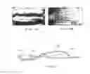 Fig. 07 - Method and apparatus for grafting of skin tissue