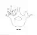 Fig. 12 - IMPLANT AND METHOD FOR FACET IMMOBILIZATION