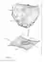 Fig. 08 - Pulmonary vein isolation gap finder