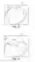 Fig. 11 - Orthodontic digital setups