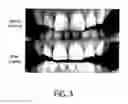 Fig. 04 - Method of forming a uniform cosmetic or therapeutic coating on teeth