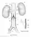 Fig. 02 - Visual stabilizer on anchor legs of vena cava filter