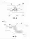 Fig. 14 - Intraocular Lens Insertion Apparatus and Lens Case