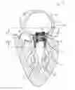 Fig. 01 - Mitral valve prosthesis