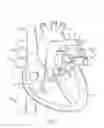 Fig. 02 - Mitral valve prosthesis