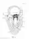 Fig. 03 - Mitral valve prosthesis