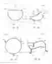 Fig. 06 - Mitral valve prosthesis