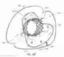 Fig. 10 - Mitral valve prosthesis