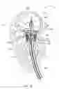Fig. 17 - Mitral valve prosthesis