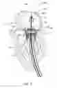 Fig. 19 - Mitral valve prosthesis