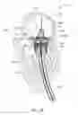 Fig. 20 - Mitral valve prosthesis