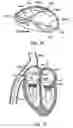 Fig. 05 - Prosthetic heart valve devices and associated systems and methods
