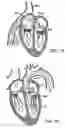 Fig. 06 - Prosthetic heart valve devices and associated systems and methods
