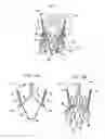 Fig. 02 - Valve suturing and implantation procedures