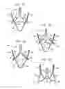 Fig. 04 - Valve suturing and implantation procedures
