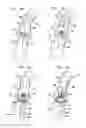 Fig. 17 - Valve suturing and implantation procedures