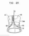 Fig. 35 - Valve suturing and implantation procedures