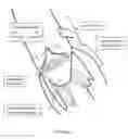 Fig. 04 - METHOD AND APPARATUS FOR MITRAL VALVE ANNULOPLASTY