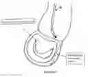 Fig. 10 - METHOD AND APPARATUS FOR MITRAL VALVE ANNULOPLASTY