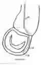 Fig. 11 - METHOD AND APPARATUS FOR MITRAL VALVE ANNULOPLASTY