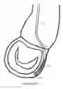 Fig. 12 - METHOD AND APPARATUS FOR MITRAL VALVE ANNULOPLASTY
